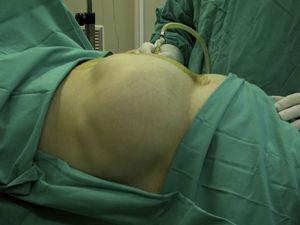 Insertion of the intraperitoneal catheter in the OR.