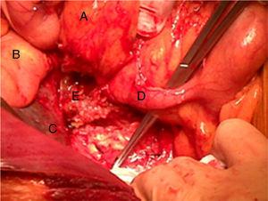 Appendicular tumor formation (clamp indicates the vermiform appendix): (A) duodenum; (B) gallbladder; (C) inferior side of liver; (D) vermiform appendix; (E) tumor formation originating at the tip of the appendix.