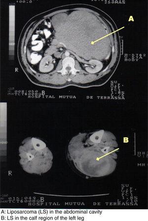 (A) Liposarcoma in the abdominal cavity; (B) liposarcoma in the calf region of the left leg.
