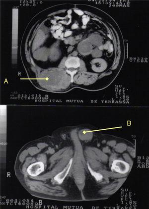 (A) Liposarcoma in the right dorsolumbar region; (B) liposarcoma in the left spermatic cord.