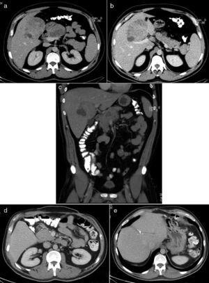 Abdominal CT: (a) cross-sectional image showing metastases in the liver and head and body of the pancreas; (b) cross-sectional image with metastasis in the liver and tail of the pancreas; (c) sagittal slice of the liver metastasis and the proximity of the metastasis in the head/body of the pancreas with the portal vein; (d and e) follow-up abdominal CT showing no evidence of recurrence or metastasis in the abdominal region.