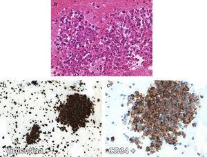 Histology images of the solitary fibrous tumor: (a) hematoxylin–eosin stain (40×) with few small, round, neoplastic cells, limited eosinophilic cytoplasm and eccentric round nuclei; (b and c) stain for immunohistochemistry study (20–40×, respectively): intense positivity of the neoplastic population for vimentin and CD34.