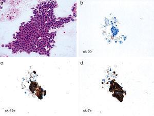Results of fine-needle aspiration: (a) hematoxylin–eosin stain (HE, 400×); (b) immunohistochemistry study ruling out expression of cytokeratin 20; (c) confirmed expression of cytokeratin 19; (d) confirmed expression of cytokeratin 7.