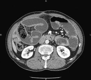 Abdominal CT: bowel obstruction due to a voluminous bezoar impact in the distal ileum; important distension of the small bowel loops.