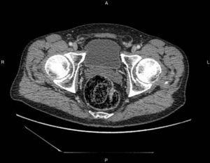 Abdominal CT: presence of partially broken down bezoar in the rectal ampulla.