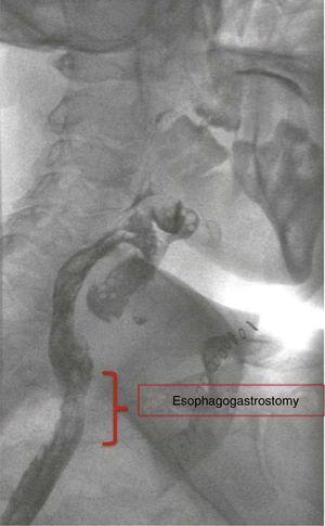 Fluoroscopy showing the esophagogastric anastomosis and proper passage of the contrast material.