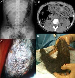 (A) Radiographic image with mixed density located in the epigastrium. (B) CT showing the stomach totally occupied by a heterogenous mass. (C) Endoscopic image of the trichobezoar. (D) Compact trichobezoar removed by gastrostomy (made up of hair, mucus and decomposing food) that had occupied the entire stomach.