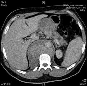 CT image showing the rupture of the descending thoracic aorta.