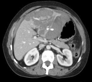 Coronal CT: liver lesion.
