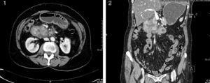 Abdominal CT showing evidence of a mass around the duodenum with cystic lesions and narrowing of the duodenal lumen.