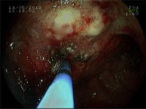 Endoscopy: mamelonated mass with diffuse hemorrhage; fulguration with argon.