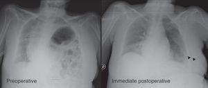 The posterior–anterior X-ray image for preoperative and immediate postoperative diaphragmatic plication (60-year-old patient with a history of polio, tetraparesis, and left symptomatic diaphragmatic hernia). Note the mediastinal shift, and the compression of both lungs and the opposite hemidiaphragm due to hernia of the left hemidiaphragm. The arrows indicate postoperative pleural drainage.