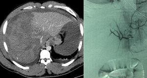 Large hepatic hematoma with signs of active bleeding and diffuse embolization of the right hepatic artery.