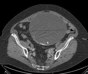 CT image where the cystic lesion is observed to occupy a good portion of the abdominal content with calcified images in its interior.