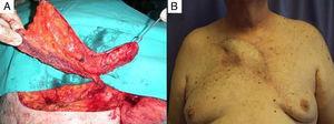 (A) Intraoperative image of the flap design where one can observe the internal mammary artery perforator and the muscular ellipse included in the design. (B) Clinical image taken 2 years after surgery, demonstrating stable coverage and recovery from the disease.