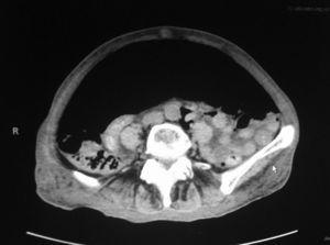 Abdominopelvic CT scan with abundant pneumoperitoneum and caudal organ displacement.