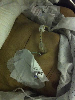 Percutaneous drainage with Abbocath and placement of a pigtail catheter.