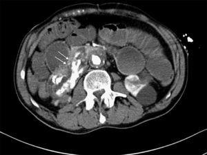 Abdominal CT scan with intravenous contrast: presence of intravenous contrast in the intestinal lumen (arrows).