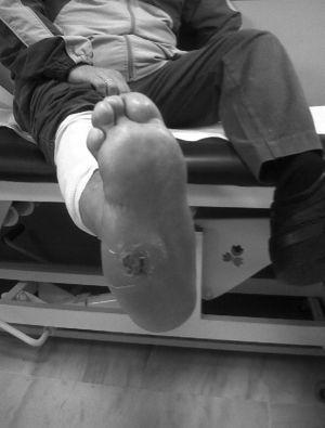 Acute Charcot Foot with ulcer and deformity. Prior amputation of the 5th toe.