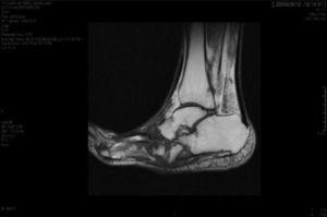 MRI showing Sanders’ Charcot Foot type II.