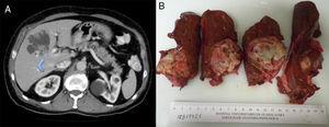 (A) Abdominal CT scan; blue arrow shows tumor infiltration of the portal vein; (B) surgical specimen.
