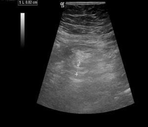 Abdominal ultrasound compatible with an acute appendiceal process and peripheral phlegmon.
