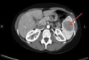 Abdominal CT: 4cm mass in the spleen (inflammatory pseudotumor)