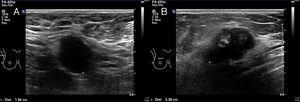 (A) Prolungamento ascellare destro che mostra una linfoadenopatia di 19 mm con perdita dell'ilo grasso e aspetto infiltrativo; e (B) alla giunzione dei quadranti del seno destro, si osserva un nodulo irregolare e mal definito (BI-RADS-IV).