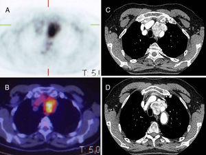 (A) Tumour uptake in PET; (B) images of fusion in PET/CT; (C and D) tumour images in CT angiogram.