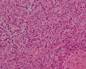 At greater magnification, atypia can be observed in the bile ducts (20×, haematoxylin–eosin).