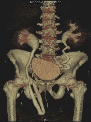3D reconstruction of a multislice CT urography showing evidence of a right ureteral hernia.