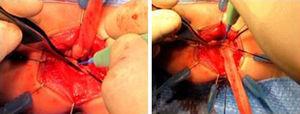 Subsequent myotomy of the rectal seromuscular sleeve to prevent compression of the pulled-through intestine.