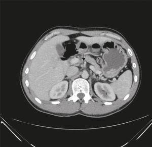 tomografia komputerowa: żyła krezkowa górna jest obserwowana z przodu i w lewo od tętnicy krezkowej górnej; wokół tego jest wirowy obraz żyły i krezki wokół tętnicy.
