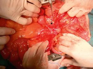 270° 最初の空腸ループの血管後通過による結腸の回転;回腸末端の腸間膜縁の静脈瘤。