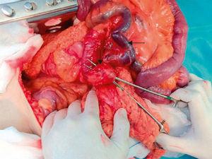intestinale band bevestigen van de caecum aan de hoek van Treitz.