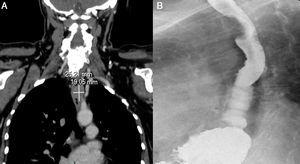 (A) Thoracic CT with i.v. contrast: submucosal stenosing oesophageal lesion measuring 2.5×1.9cm in craniocaudal length and 3.4cm cross-wise from the carina at its lower edge. (B) Barium oesophagogastric transit study: in the thoracic oesophagus, a smooth repletion defect is observed, compatible with submucosal mass.