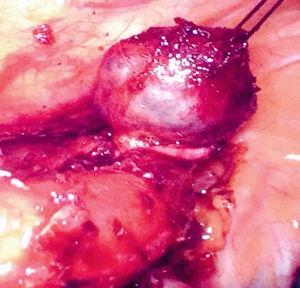 Thoracoscopic enucleation of the oesophageal mass.