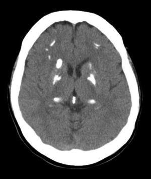Axial CT: calcifications observed in bilateral frontal and periventricular basal ganglia.
