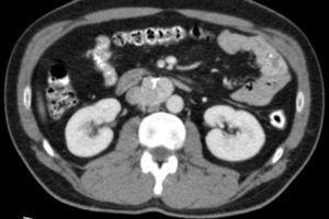 Paraganglioma of Zuckerkandl's Organ | Cirugía Española (English Edition)