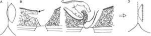 Diagramas da técnica utilizada: (A1) a pele é marcado com um excêntrico elipse 2 cm da linha média; (B1) a seta indica como uma aba é criada na borda medial que é 1cm de espessura e 2cm de longa; (C1) sutura das bordas inferior e interna do retalho à fáscia pré-sacral para cobrir o defeito; (D1) resultado final, com suturas.