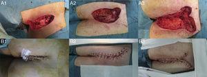  Chirurgische Bilder der 3 Patienten vor und nach der Rekonstruktion: (A1 und B1) Patient 1, (A2 und B2) Patient 2 und (A3 und B3) Patient 3.