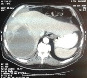 CT: liver abscess.