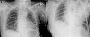 (A) Simple chest X-ray 24h after surgery; (B) Simple chest X-ray with condensation in the left upper lobe 48h after surgery.