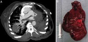 (A) Thoracic CT scan showing signs of left lobe torsion; (B) Hepatized left upper lung lobe.