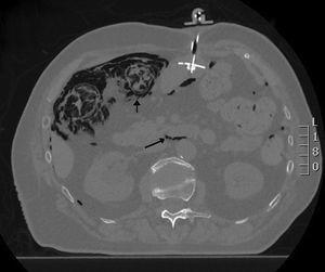 Axial CT scan: presence of pneumoperitoneum and retropneumoperitoneum; right colon is striated in appearance, in layers, with presence of gas in the wall; PEG.