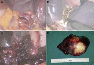 (A) Inferior splenic pedicle; (B) marking of the parenchyma; (C) dissection of the parenchyma; and (D) surgical specimen.