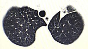 A semisolid lesion is observed in the left upper lobe.