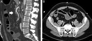 (A) CT angiography showing evidence of a small filling defect at the origin of the ileocolic artery (white arrow); (B) localized ileal loops with thickened walls suggesting intestinal suffering.