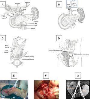 (A) Donor organ procurement technique; (B) bench: iliac artery Y anastomosis of the graft with the superior mesenteric artery (SMA) and splenic artery (SA); (C) implantation in the right iliac fossa: arterial anastomosis between the Y end of the graft with the common iliac or external artery of the recipient and venous anastomosis between the portal vein of the graft with the common iliac vein or vena cava of the recipient and duodenal-vesical anastomosis with a mechanical stapler; (D) implantation in the right iliac fossa with side-to-side duodenal-jejunal anastomosis with the head of the pancreas in cranial position; (E) graft on the bench; (F) vascular anastomoses and reperfused graft; G) MRI image with pancreatic graft n the right iliac fossa and renal graft in the left iliac fossa.