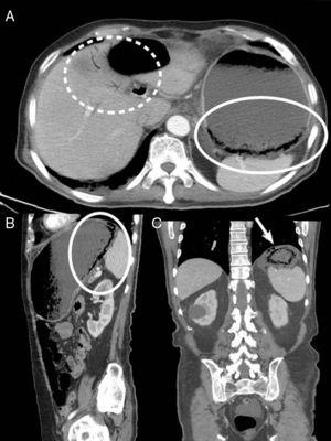 Abdominal-pelvic CT with intravenous contrast in axial (A), sagittal (B) and coronal (C) planes, showing important gastric distension with limited wall enhancement in the fundus, where multiple intramural gas bubbles are observed, suggestive of gastric pneumatosis (circle), free fluid and bubbles of ectopic gas (arrow), as well as venous gas in left main portal branch and distal portal branches of the left hepatic lobe (dashed circle).